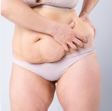 What Is a Tummy Tuck?