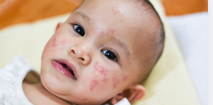 What is the Most Common Food Allergy in Babies?