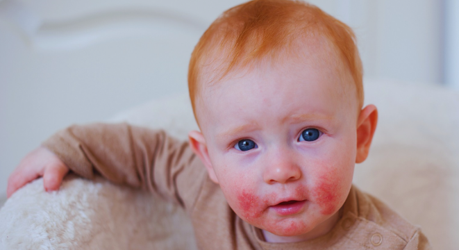 Tips for Parents of Allergic Babies