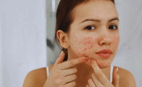Understanding Teenage Skin Types
