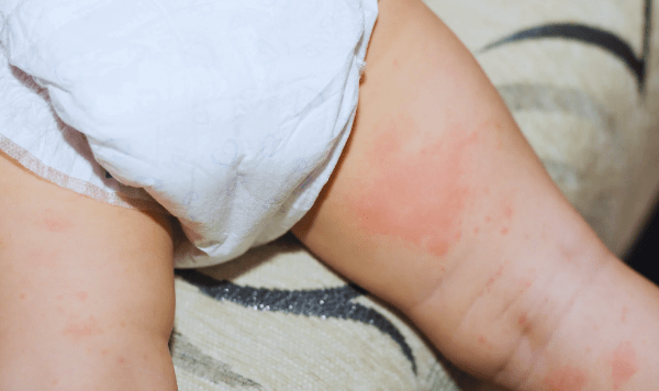What Is Diaper Rash?