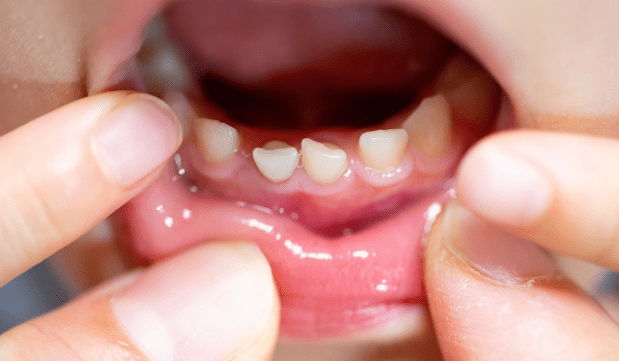 How Many Teeth Do Kids Have?