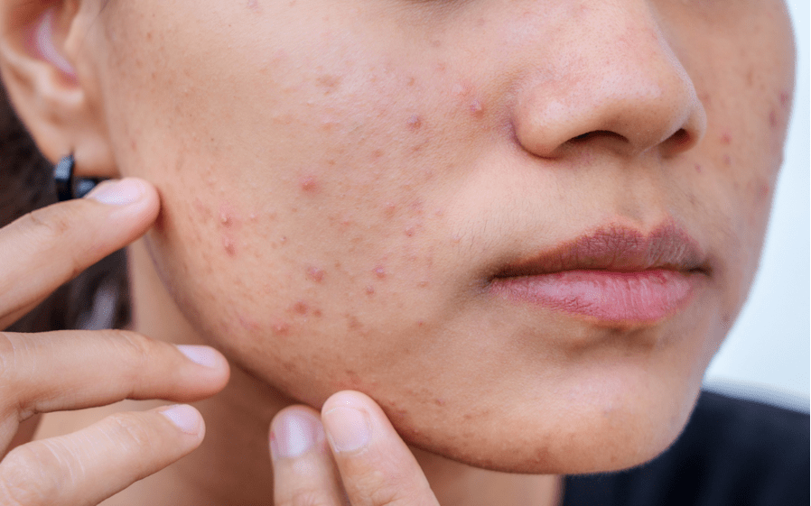 Understanding Acne-Prone Skin in Teens