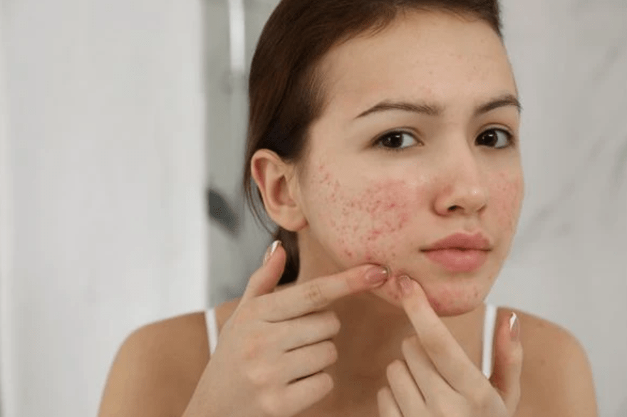 What Are Blackheads and Whiteheads?